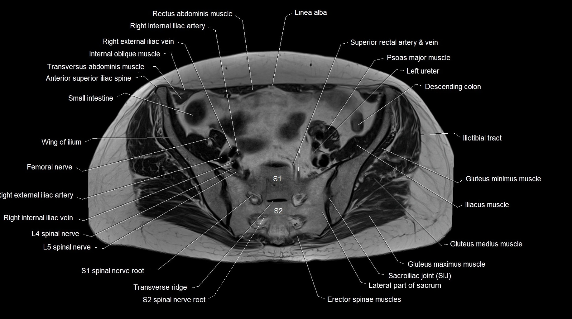 MRI 3T pelvis axial cross section anatomy image 12.webp